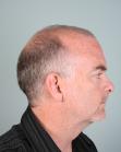 Before Hair Transplant&nbsp;2 Sessions (Areas)
